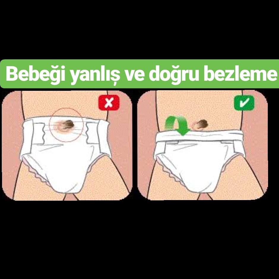 Merhabalar,
Dokunmaya kıyamadığımız, hatta dokunurken acaba acırmı diye korktuğumuz "Göbek Bağı Bakımı" yenidoğanda çok önemlidir. Gerektiği gibi bakılmamasi halinde minik bebeğinizin antibiyotik alması dahi gerekebilir. #salı #benibulanne #kaynakönerim #healty #baby #newborn