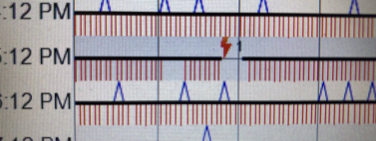 MLPS911's tweet image. If you want to know how good our medics are at performing a resuscitation just look at this sequence of events. Short analysis period, CPR while charging, and a 0 second pre-shock pause. This patient survived. #skilledparamedics  #HPCPR @ResuscAcademy @LDNParamedics @OneFourSeven