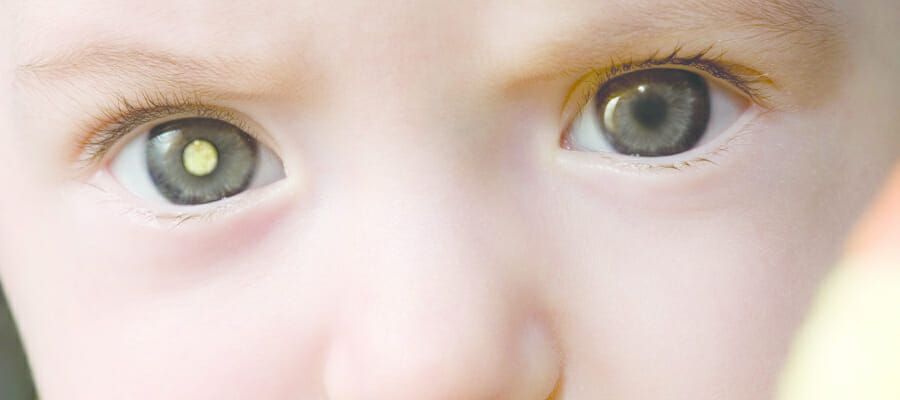 Retinoblastoma (Rb) is a type of eye cancer that affects young children, mainly under the age of six. The most commonly reported sign of Rb is a 'white glow' in the eye. Here's a useful guide on what to do if you ever spot it. buff.ly/2pKf9bD #RbWeek
