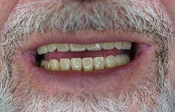 CBCDental's tweet photo. We were able to assist this patient with our removable #dentures, to help him truly transform his smile. https://t.co/y0GEKRQbT9