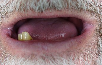 CBCDental's tweet photo. We were able to assist this patient with our removable #dentures, to help him truly transform his smile. https://t.co/y0GEKRQbT9