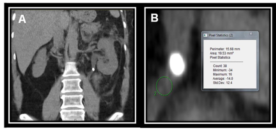 Can preop CT be used to predict impacted stones? Our model indicates HU under stone can predict impaction. <a href="/MantuGuptaMD/">Mantu Gupta, M.D.</a> sciencedirect.com/science/articl…