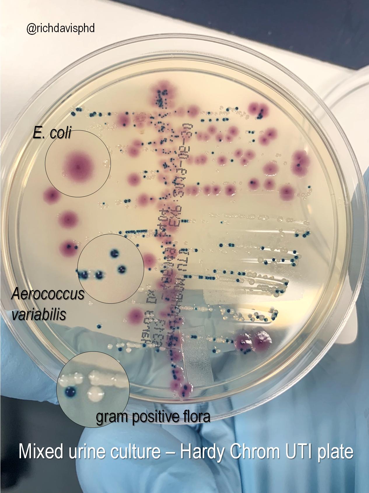 Rich Davis Phd D Abmm Mls Tren Twitter Microrounds Day 449 Mixed Results Urine Culture Plate On Chromogenic Agar Mauve E Coli Teal Usually Enterococcus But This Turned Out To Be