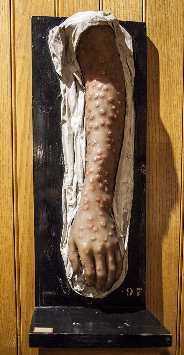 DYK on this day in 1796, the first #smallpox #vaccination was administered by #EdwardJenner? This wax model of an arm infected with smallpox is a reminder of how gnarly smallpox is and how grateful we are for the vaccine!