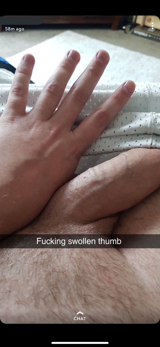 ScottishBantrr's tweet photo. that’s one swollen thumb https://t.co/T8zd7AtTY7