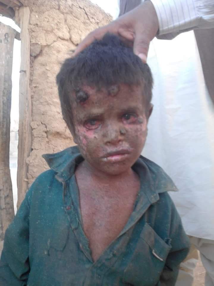 web_bolan's tweet photo. بلوچستان کا  ضلع کچھی  کی   عوام کو نظر انداز کیا جا رہا ہے اگر یہ خطرناک بیماری اسلام آباد اور لاہور جیسے شہروں میں نمودار ہوتی اور اس کا شکار امراء کے بچے ہوتے تو اشرافیہ سمیت پورے پاکستان میں میڈیا کی چیخیں نکل جاتیں اور ہنگامی بنیادوں @jam_kamal @ZahoorBuledi https://t.co/FGPfyFA60L