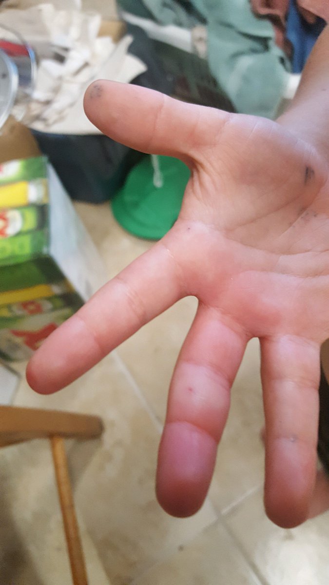 Huntingtec's tweet image. Well it's that time of the year when calf's are born and everything that can stick you, bite you or sting you are out among us! Christopher got tagged twice for the first time by a red wasp, and he is a now believer in apple cider vinegar!