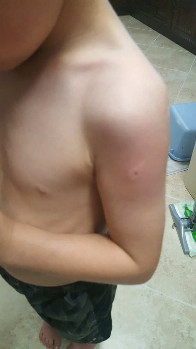 Huntingtec's tweet image. Well it's that time of the year when calf's are born and everything that can stick you, bite you or sting you are out among us! Christopher got tagged twice for the first time by a red wasp, and he is a now believer in apple cider vinegar!