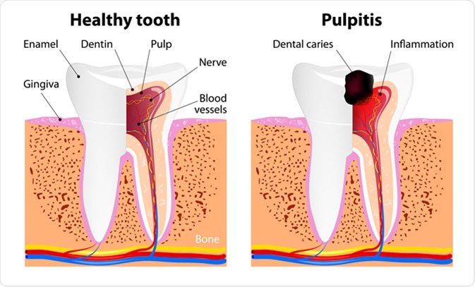 NewsMedical's tweet image. What is Pulpitis? news-medical.net/health/What-is… #Pulpitis #Teeth #Dentistry #Dental