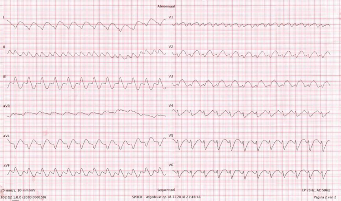 escardio's tweet photo. A 30-year-old woman, recurrent syncope; BP 90/60 - What's your initial management?
A/ Adenosine 6 mg IV
B/ Amiodarone 300 mg IV
C/ Metoprolol 5 mg IV
D/ Sedation + electrical synchronised cardioversion
#ACUTECVDAYS #cardiotwitter #cardioed #ESCACCA #acutecare https://t.co/NsptM4nNCT