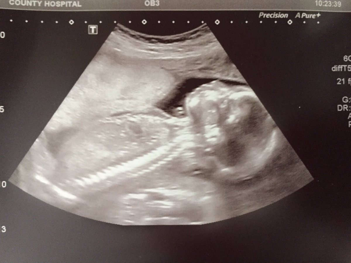 Rich_Cooke1's tweet image. Looking forward to meeting my second son in September 🤗🤞🤞#20weekscan