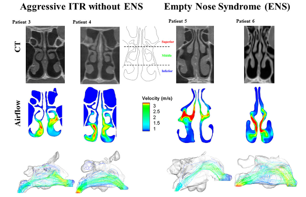 ifar_journal's tweet photo. What's the latest on #ENS? Researchers from @OSUWexMed used computational fluid dynamic analysis on patients who underwent turbinate surgery to shed light on this rare disorder. Read more @ifar_journal: https://t.co/RixNqW8Ofa #emptynose #turbinatereduction #nasalsurgery https://t.co/G3NGJbUjcY