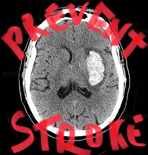 #StrokePrevention
Did you know that treating /Modifying these #RISKFACTORS can minimize your risk for stroke ?

1. #Highbloodpressure 
2. #Diabetes 
3. #Smoking 
4. #Physicalinactivity 
5. #Carotidarterydisease
6. #Atrialfibrillation
7. #HighCholesterol
