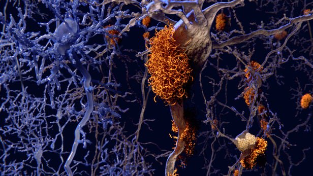 universe_techno's tweet image. #болезньальцгеймера #испытанияналюдях #исциление #мозг #новыйпрепарат #поражениемозга

Лекарство от болезни Альцгеймера проходит первую фазу испытаний на людях

tech-universe.mcdir.ru/lekarstvo-ot-b…