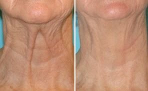 NonSurgicalFace's tweet photo. Skeletal Throat Hassles Could Be Over Applying These Throat Development Exercise Methods https://t.co/qCQdfJ9Z4r https://t.co/SCFoWtS3J1