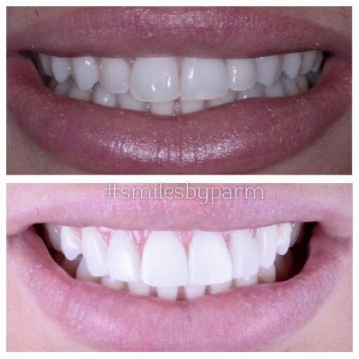 🤗Before &amp; After Cosmetic Bonding🤗 #SmilesByParm #VivaDentalStudio #Dentist <a href="/Mr_Simms_Hx/">MrSimmsHornchurch</a> <a href="/bestsellers_sx/">Best Sellers</a> <a href="/PinkParachute1/">The Pink Parachute</a> <a href="/EssexTiptoes/">Tiptoes (Essex) Limited</a> @HomeSweetHomeHx <a href="/hornchurchTT/">Hornchurch Town Team</a> <a href="/Day2DayStat/">DAY 2 DAY STATIONERY</a> <a href="/BoyAboutTownLTD/">BoyAboutTown Barbers</a> <a href="/suttonarmshorn/">The Sutton Arms</a> @BaskingbabiesLT <a href="/Abbeycraft23/">Abbeycraft Artworld</a> <a href="/ExtendedEducat1/">Extended Education</a> <a href="/QueensTheatreH/">Queen's Theatre Hornchurch</a>