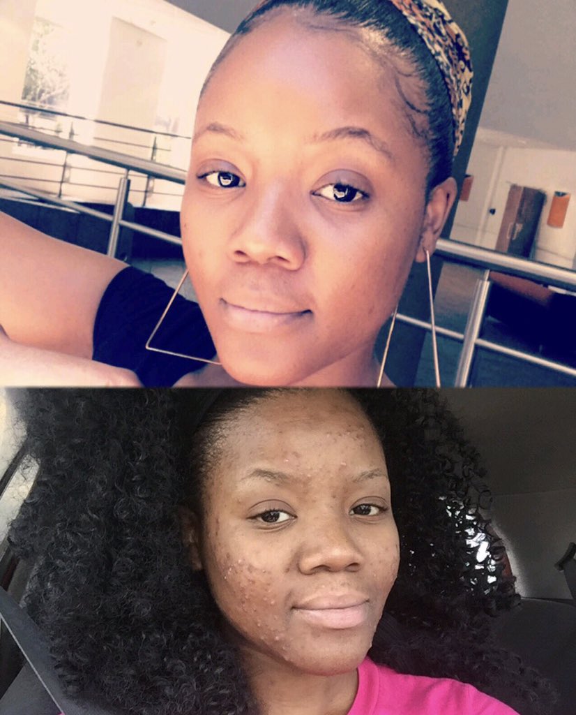 MissGeeKays's tweet photo. 7 years of TEARS....PAIN, ISOLATION and PUBLIC  SCRUTINY .I am glad it’s all over . 7 years later I am ACNE free 😭😭🙏 https://t.co/SyOZxwsl2v