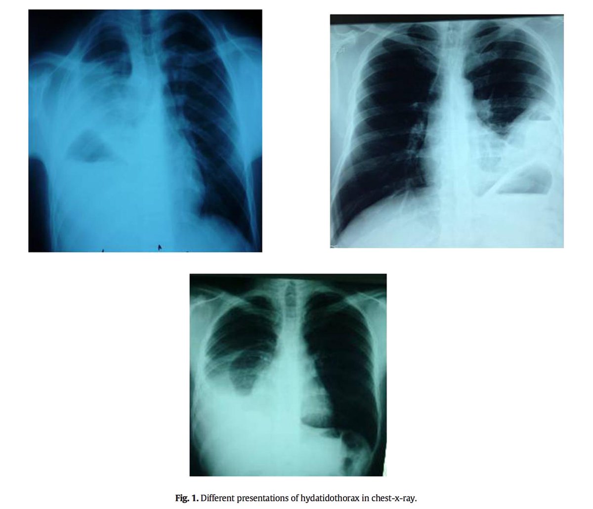 jpedsurg's tweet photo. Surgical treatment of hydatidothorax in children: A retrospective study of 19 patients https://t.co/DMe4nzzvnX #jpedsurg #PediatricSurgery #Hydatidcyst #retrospectivechartreview https://t.co/GXkS90jTtx