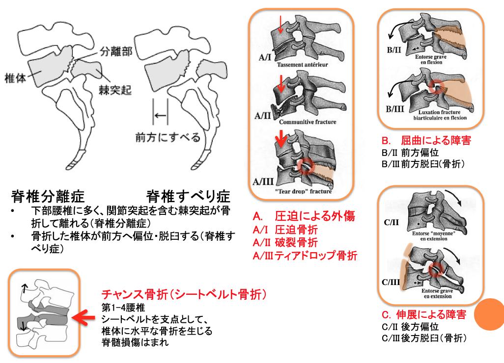 Twitter पर Oj 脊椎の外傷 椎間関節を骨折 脊椎分離症 すると 椎体が前方脱臼する 脊椎すべり症 頸椎の過屈曲では前方脱臼 を生じる 前方脱臼では運動麻痺を伴う場合が多い 頸椎の過伸展では後方脱臼を生じる 運動麻痺が生じるかどうかは場合による