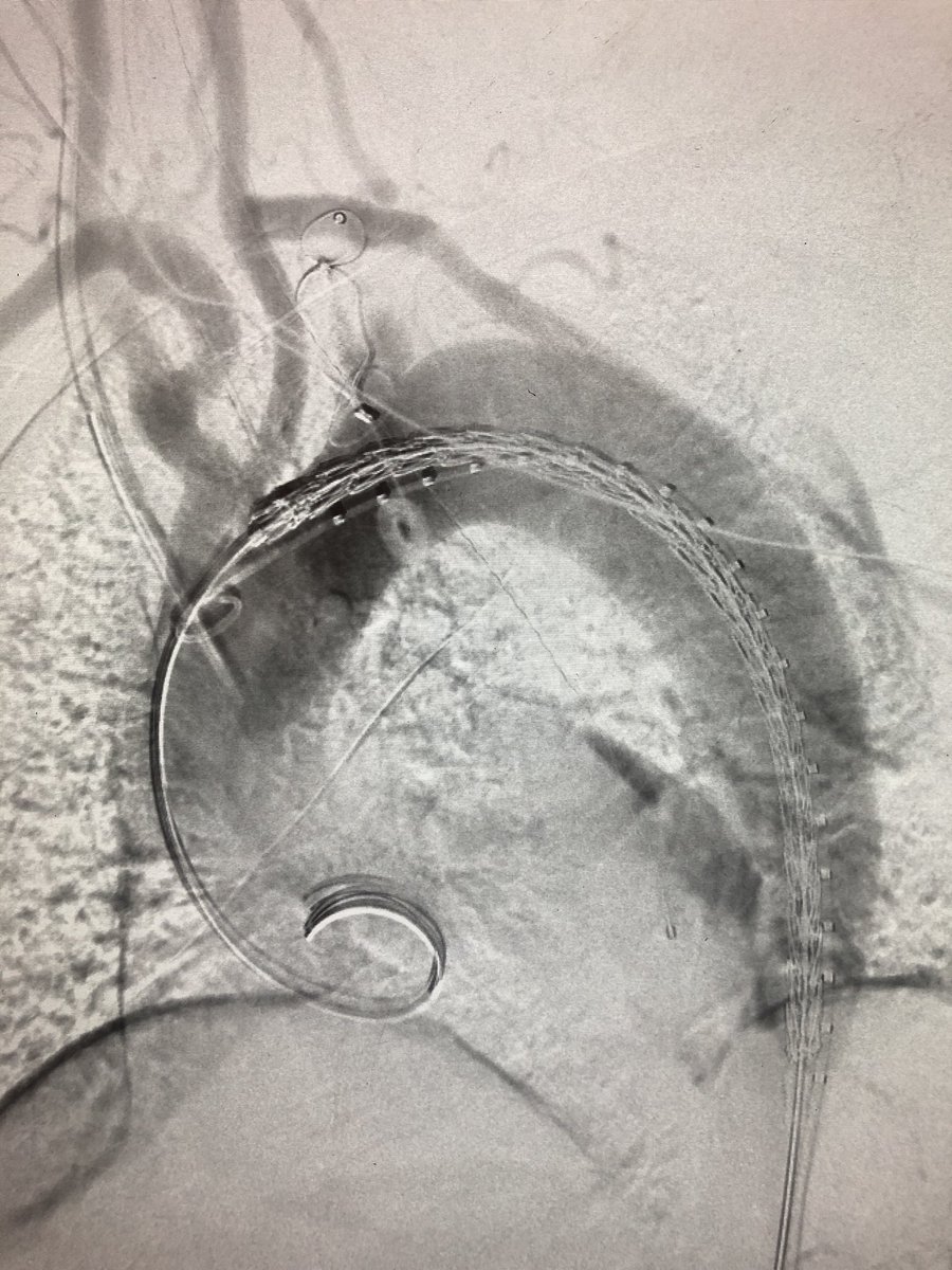DrAliAzizzadeh's tweet photo. #Acute #complicated #typeB #aortic #dissection with renal #malperfusion treated with #TEVAR #LSCA #bypass #embolization #vascularsurgery @CedarsSinai https://t.co/NOMd6hivCo