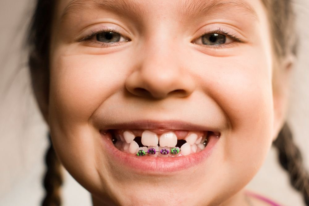 PerimeterPed's tweet photo. If your pre-teen is showing signs that they might need braces, come in for a consultation and we will give them a full evaluation! #Perimeter #Pediatric #Dentistry #GA https://t.co/30hlTt2Gbw
