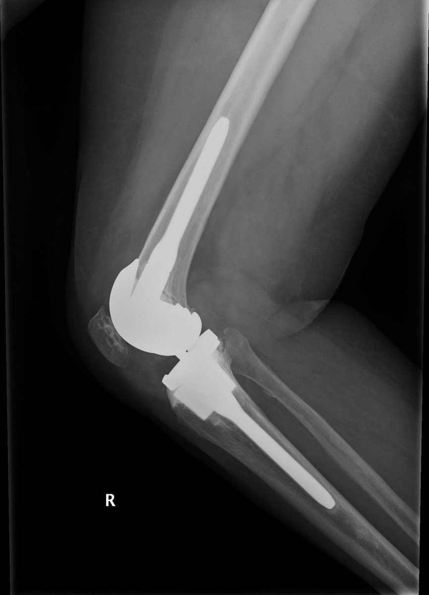 DrAdrianBarrera's tweet photo. #Osteolisis + aflojamiento #aséptico en #prótesis de #rodilla con defecto óseo tipo lll AORI en meseta tibial.
🔹Indicación clara del uso de conos de metal trabecular para restablecer la línea articular. @ICJRortho @ClinicaCEMTRO https://t.co/ayRPN0k2Ub