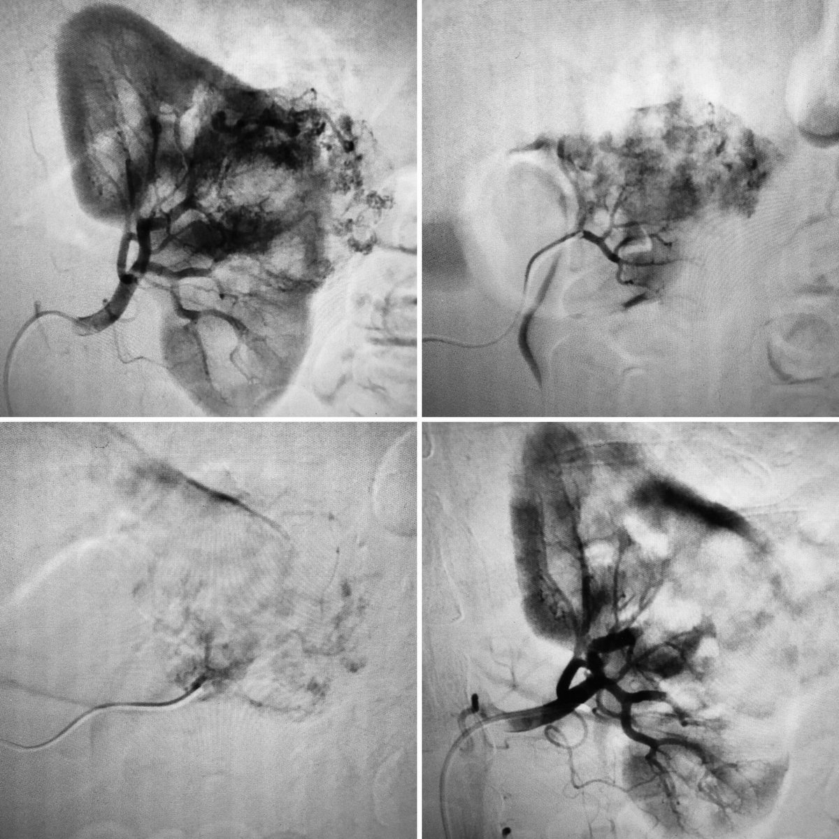 Young woman with 5.8cm renal AML - day case particulate embolisation whilst listening to her music choice of Take That! #TheGreatestDay #IRad #Withoutascalpel