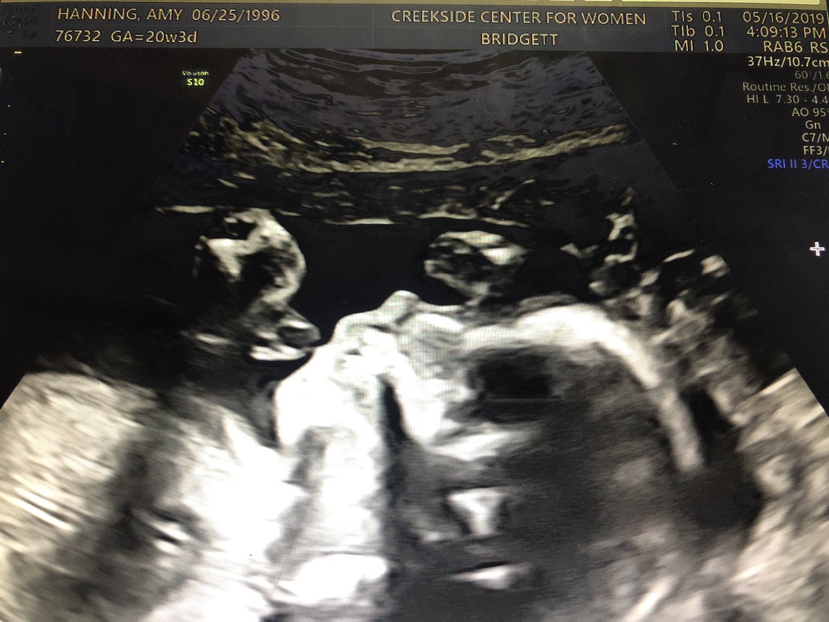 AmyLawrence0530's tweet photo. Hey Liberals, we got to see our 20 week gestation Baby Boy today. 
Sucking on his fingers, wiggling everywhere, snapping, swallowing, and kicking - With his strong little heart beating away. 
Explain to me how he doesn’t have rights, or how he isn’t human? 
#ProLife https://t.co/irqgR8ssD2