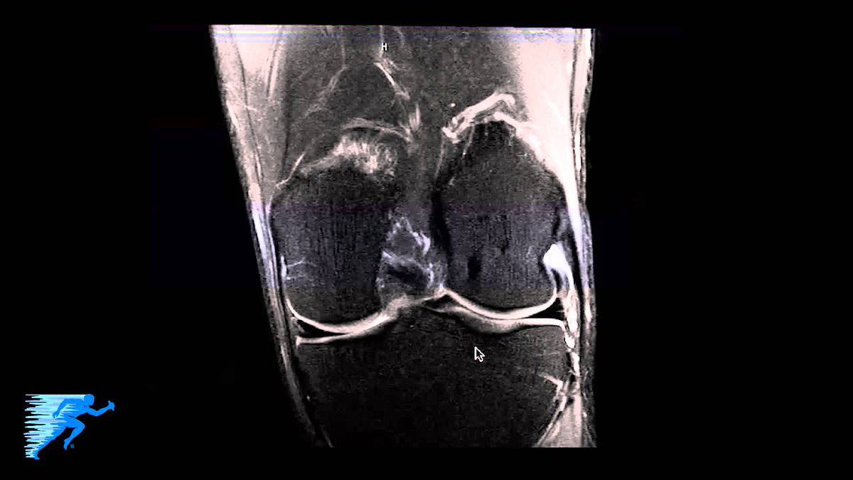 thekneedoc's tweet photo. How to Read an #MRI of a #NormalKnee
In this video, through the use of magnetic resonance imaging, clinicians can diagnose ligament and #meniscalinjuries along with identifying #cartilagedefects #bonefractures and bruises. https://t.co/V0tNxmmvNq https://t.co/SSzYeGLPzh