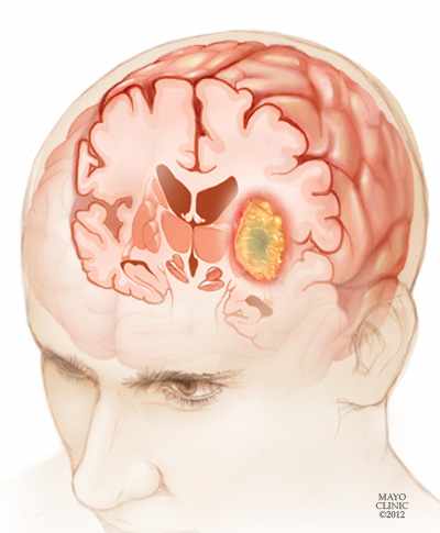 MayoClinic's tweet photo. Gliomas are one of the most common types of primary brain tumors. The exact cause of #glioma is not known, but there are some factors that may increase your risk of a #BrainTumor. https://t.co/zpDBkRZGtR https://t.co/dcHI3Cwhdz