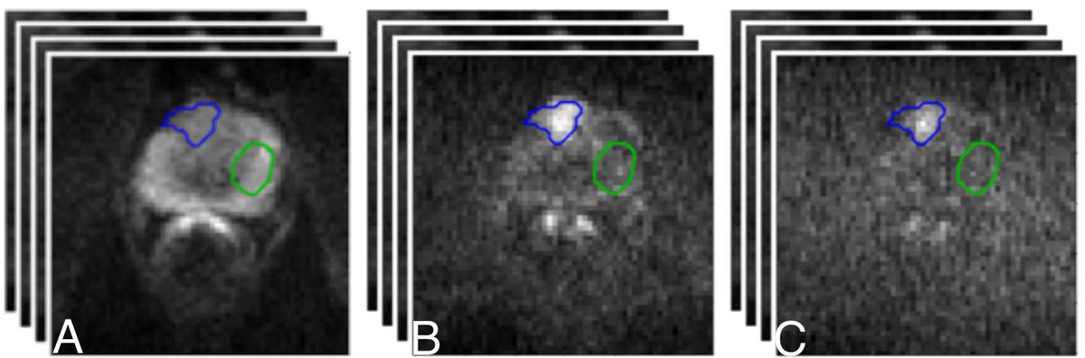 adc prostate