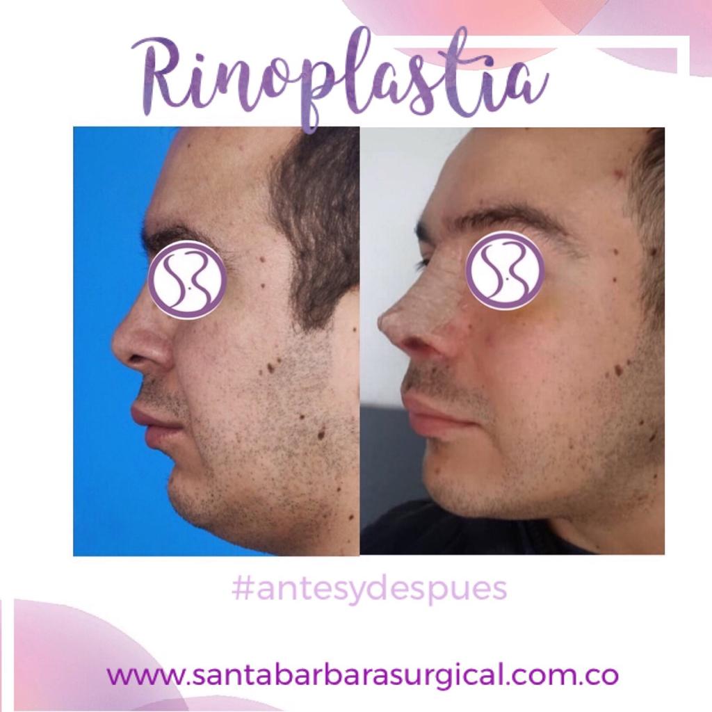 santasurgical's tweet photo. La Rinoplastia es un procedimiento que cambia la estructura interna y en la forma de la nariz, logrando resultados más acordes con el rostro.Una punta más fina y un dorso delicado,hacen una mejor apariencia.Agenda una cita y conoce sobre este procedimiento:2571399- 320 4911282. https://t.co/UTyyhnG7YT