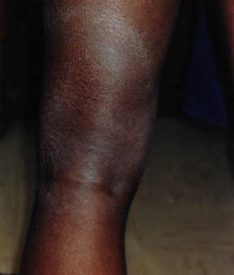 Not all Lyme disease rashes have a bull'seye appearance. Cooper