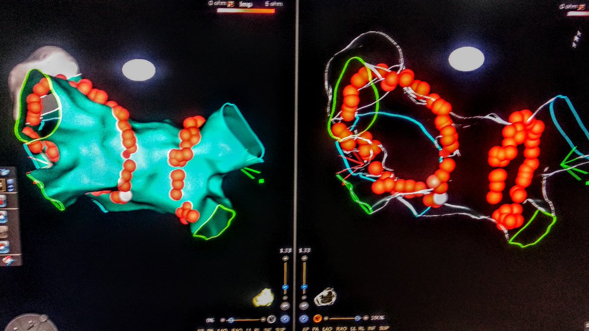 #Glassmode
Another day, another AF
<a href="/EPeeps_Bot/">EP_Bot</a> @BiosenseWebster #ablateaf, <a href="/LeandroTomasEP/">Leandro Tomas</a> , <a href="/fedecruz9/">federico cruz</a>