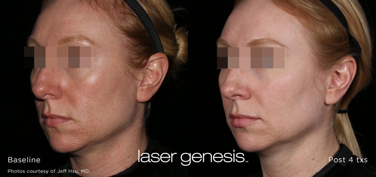 When you look in the mirror, do you see unwanted fine lines, large pores and or skin redness? Laser Genesis is the perfect answer to rejuvenate your skin! dermalasercenterny.com