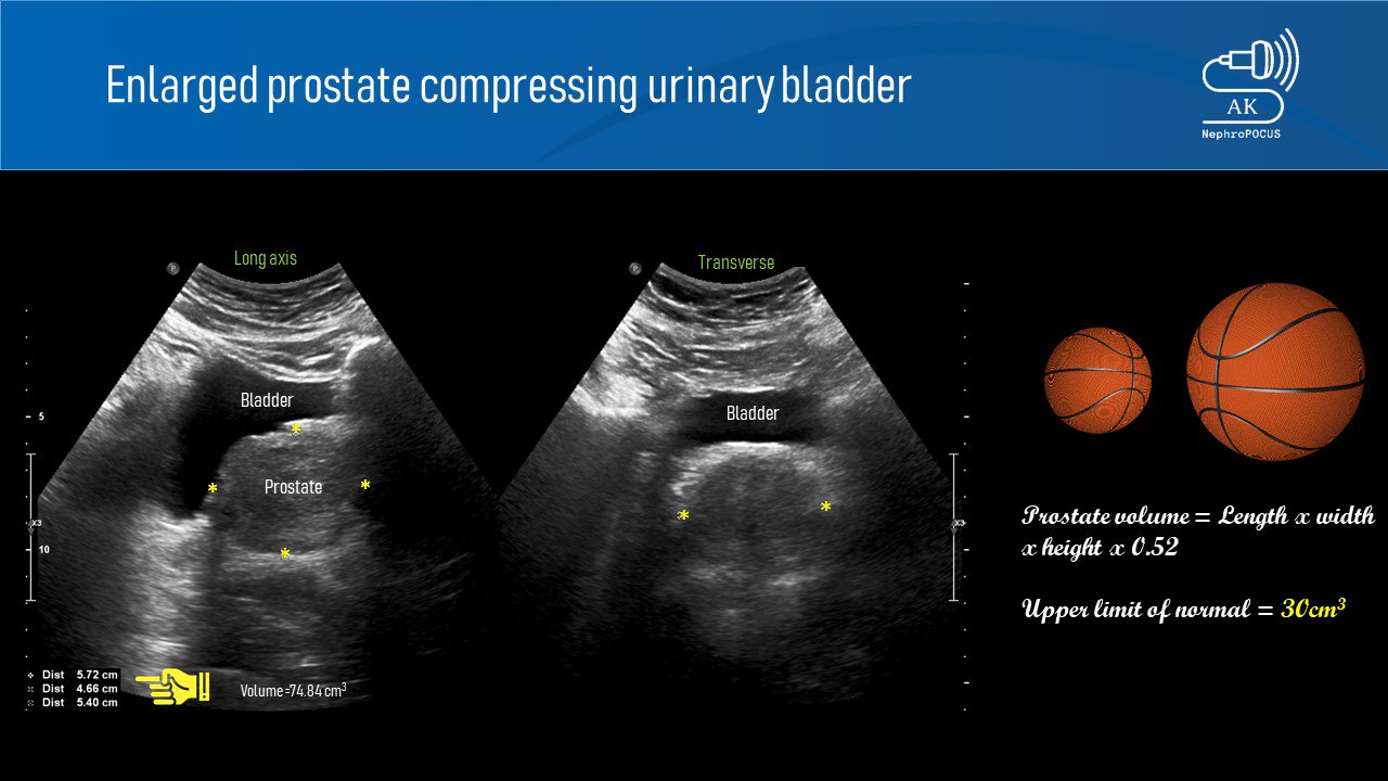 normal prostate volume ultrasound)