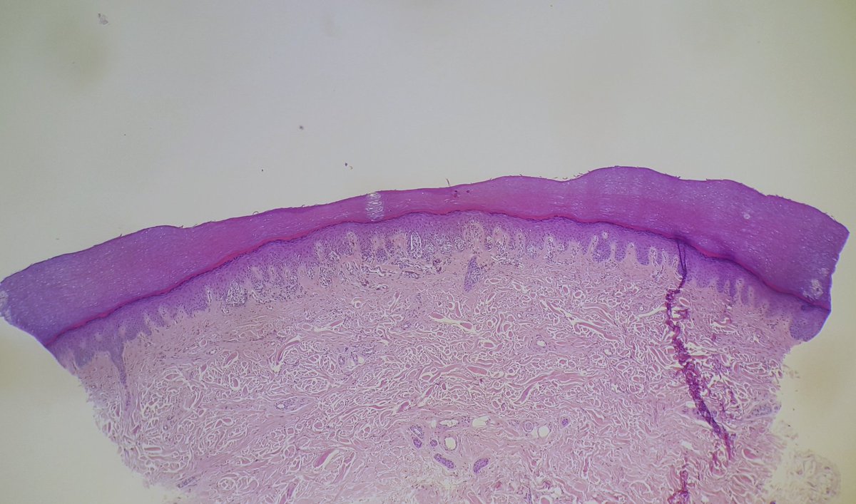 Dermpath trivia of the day: there is usually an area of keratin thinning over melanocytic lesions with a junctional component on acral skin. Seems of no real diagnostic value, just interesting.... #dermpath #pathology #dermatology