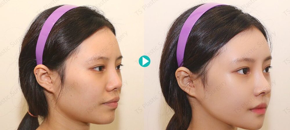 ほっぺちゃん 輪郭dt בטוויטר 鼻にカーブつけるととっても童顔で可愛い