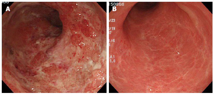 DrWangG's tweet photo. Indigo Naturalis Treats Ulcerative Colitis. https://t.co/uMrVI8QJfl https://t.co/4By7ScrWgW