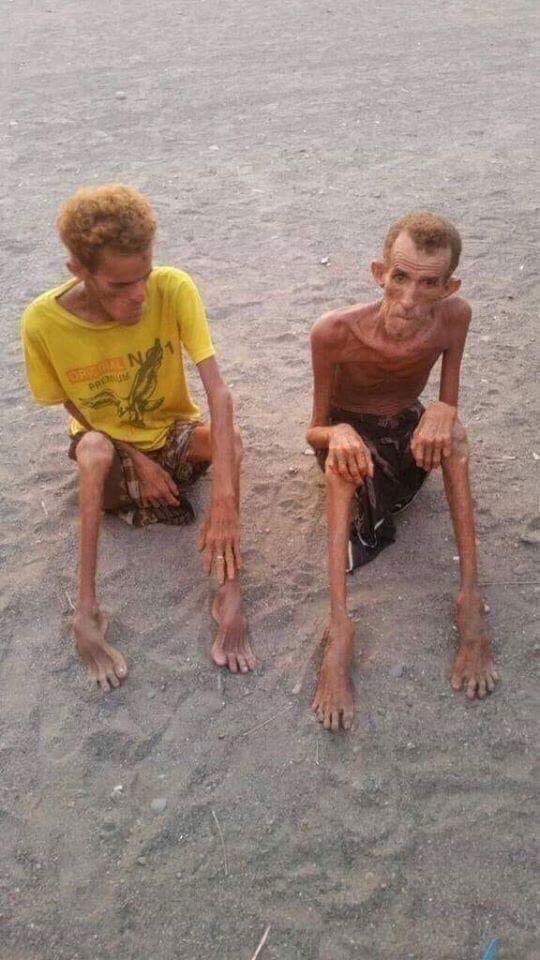 Nangbenji's tweet photo. Before our very own eyes. This is in Yemen and they have been heavily stricken by famine for more than four years now. We cannot turn a blind eye to their sufferings. https://t.co/iIpGBiS2Iv