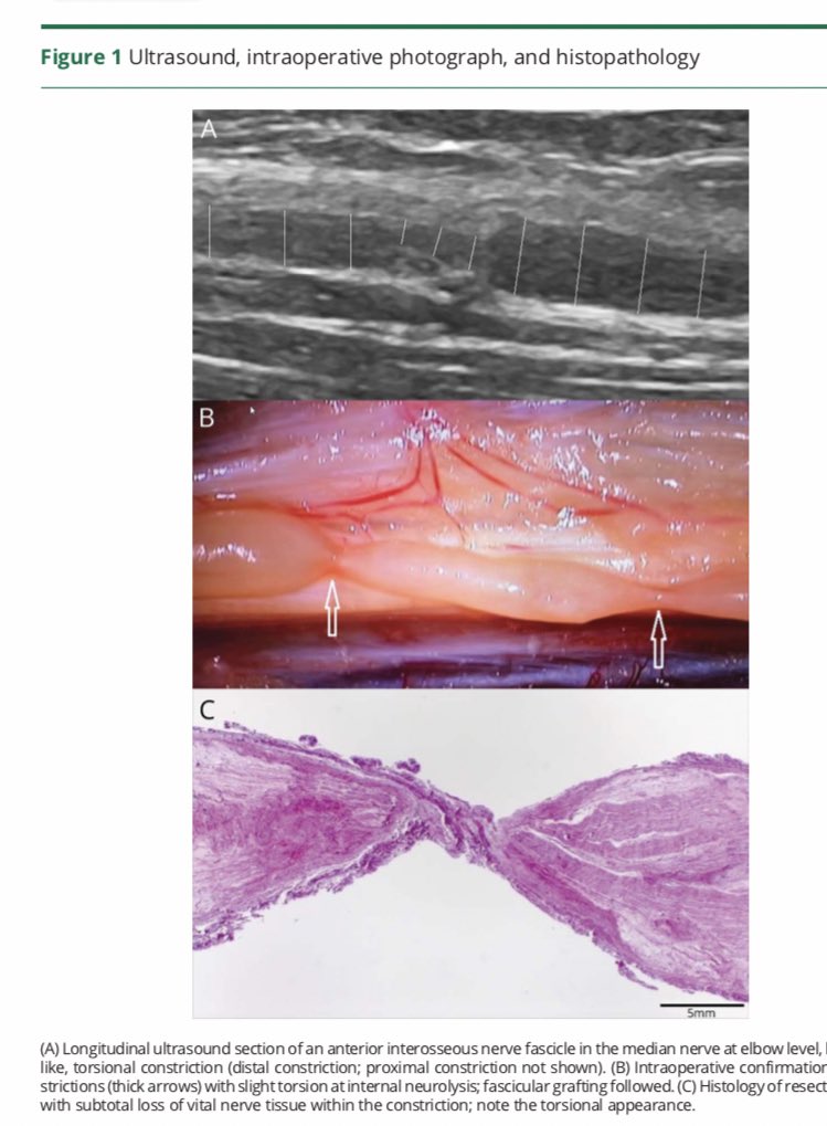 aartisarwal's tweet photo. Torsion of the nerve Parsonage Turner @AANMember @AANEMorg @journal_nd #nerve           https://t.co/pExtzNIC4E https://t.co/PusckSotVH