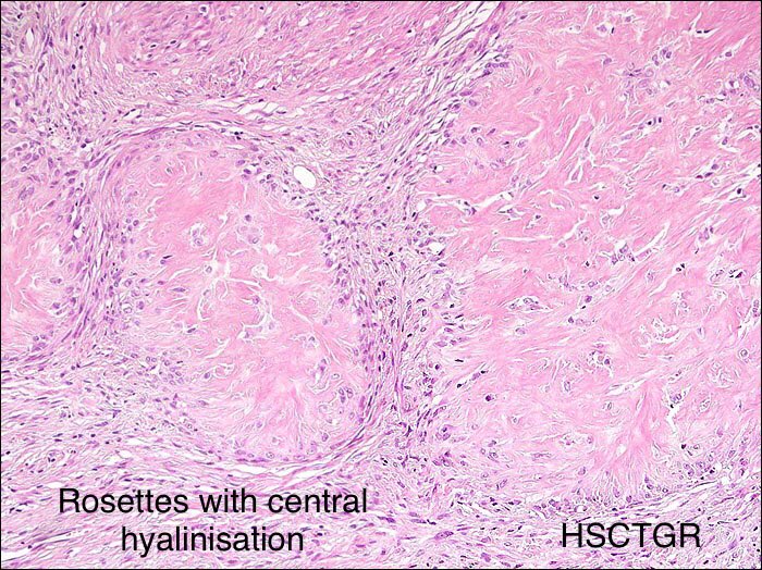 🧩Hyalinising Spindle cell tumor with giant rosettes (HSCTGR)
-A variant of LGFMS
-MUC4+
-S100 patchy/absent
Pic USCAP virtual slide box.