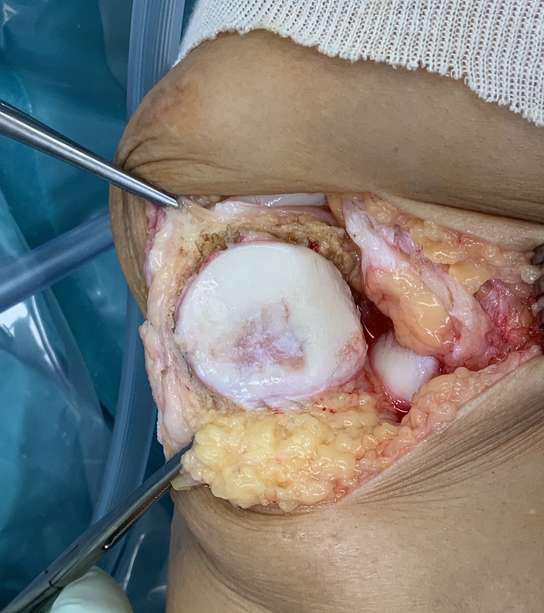 doctorgelber's tweet photo. Si tiene una lesión grave de cartílago de rodilla y es menor de 50 años, en @HospitalSantPau realizamos trasplante de cartílago fresco, único centro de derivación en Catalunya. Tambien se aceptan de fuera. Info a info@drgelber.com. RT🔁si conoce alguien que pudiera beneficiarse https://t.co/L9dCu6NFGh