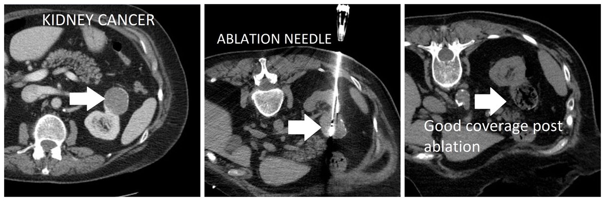 Fantastic exchange of #IRad information while helping proctor the @BTGIO renal ablation advanced users course w/ Drs Callstrom (<a href="/MayoClinic/">Mayo Clinic</a>), Georgiades (<a href="/JohnsHopkinsIR/">Johns Hopkins IR</a>), <a href="/shamaryoungmd/">Shamar Young MD</a>, &amp; Harrell (<a href="/VUMChealth/">Vanderbilt Health</a>) 

This #patient was treated <a href="/uab_ir/">UAB IR</a> thru a nick in the skin!