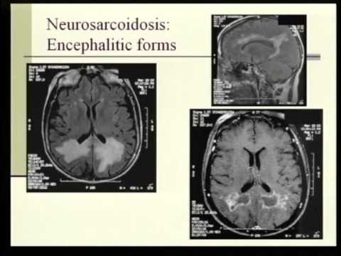 NeurosciScience's tweet photo. Sarcoidosis is a multisystem disease process of unknown etiology whose pathogenesis involves formation of an inflammatory lesion known as a granuloma.  https://t.co/Ono1C50tR0 https://t.co/6UNROeA9jl