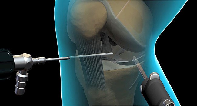 Everything You Need to Know About Arthroscopic Surgery
(ow.ly/CgXx30onHCF)

#arthroscopy #arthroscopicsurgery #FriscoTX