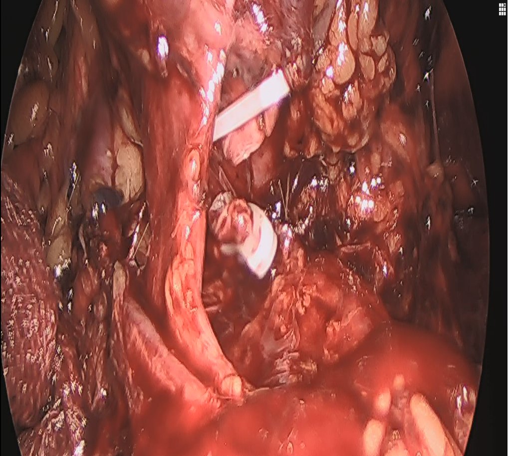 danielrojasonc1's tweet photo. Nefrectomia laparoscópica!! Manejo del pedículo renal 😷 https://t.co/d4A5pIn0g7