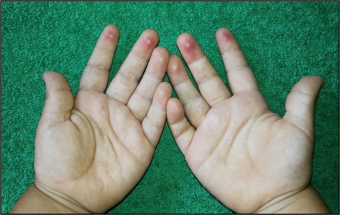 revistaPAP's tweet image. #NotaClínica

#Pulpitis palmar de las piscinas: un diagnóstico que considerar
Delicia I. Gentille Lorente

pap.es/articulo/12799…