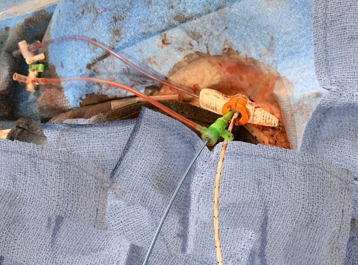Khanjan Shah (@khanjanshahmd) on Twitter photo Single access #protectedpci for #chip. Simple and slick. #bicath <a href="/duanepinto/">Duane Pinto MD MPH</a> <a href="/abiomed/">Adv Biomed</a> <a href="/rwyeh/">Robert W. Yeh</a> <a href="/MarieF_Poulin/">Marie-France Poulin, MD</a> <a href="/EricSecemskyMD/">Eric Secemsky MD MSc</a> Single access #protectedpci for #chip. Simple and slick. #bicath <a href="/duanepinto/">Duane Pinto MD MPH</a> <a href="/abiomed/">Adv Biomed</a> <a href="/rwyeh/">Robert W. Yeh</a> <a href="/MarieF_Poulin/">Marie-France Poulin, MD</a> <a href="/EricSecemskyMD/">Eric Secemsky MD MSc</a>
