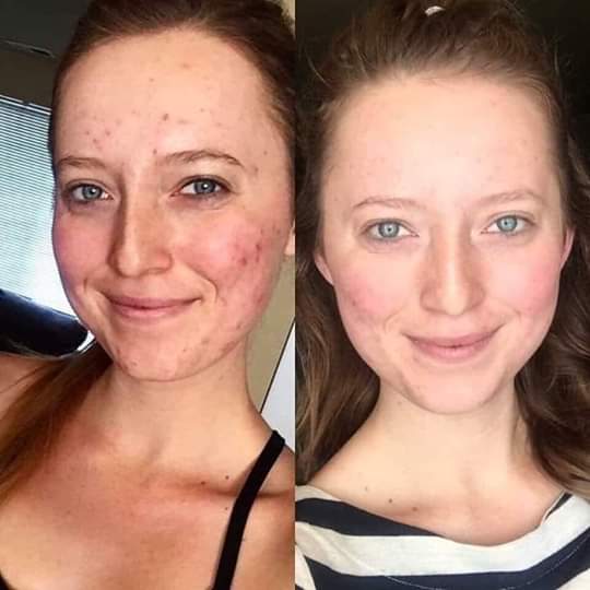 SnidelisLisa's tweet image. As we age our cell turnover rate slows down~In normal function skin excess dead skin cells r constantly being sloughed away naturally~In acne-prone skin they remain stuck on skin&apos;s surface &amp;amp; w/i the follicle creating a clog 

#ProprietaryTechnology

lisasnide.thrive123.com